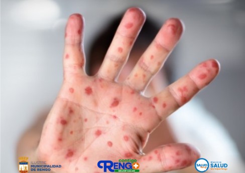 Caso Importado de Sarampión.